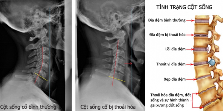 Neck Pain