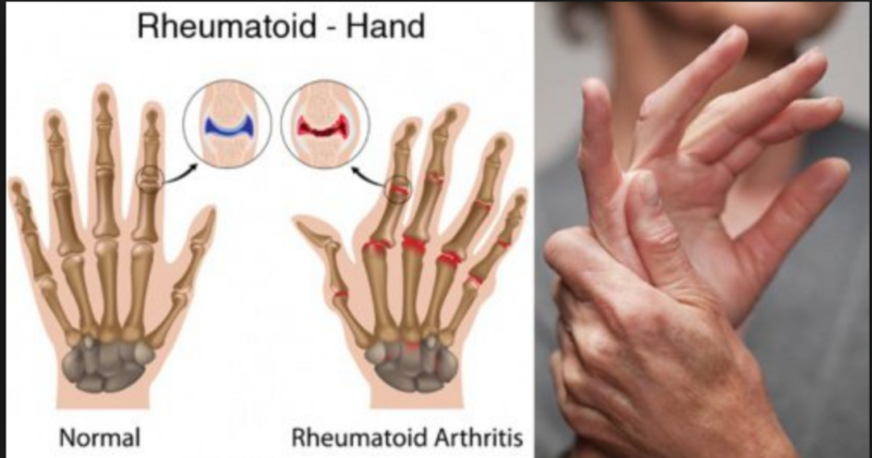 Rheumatoid Arthritis 2